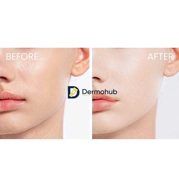 آمپول کوچک کننده منافذ سنتلا اسکین Skin 1004 مدل Poremizing Fresh SKIN 1004